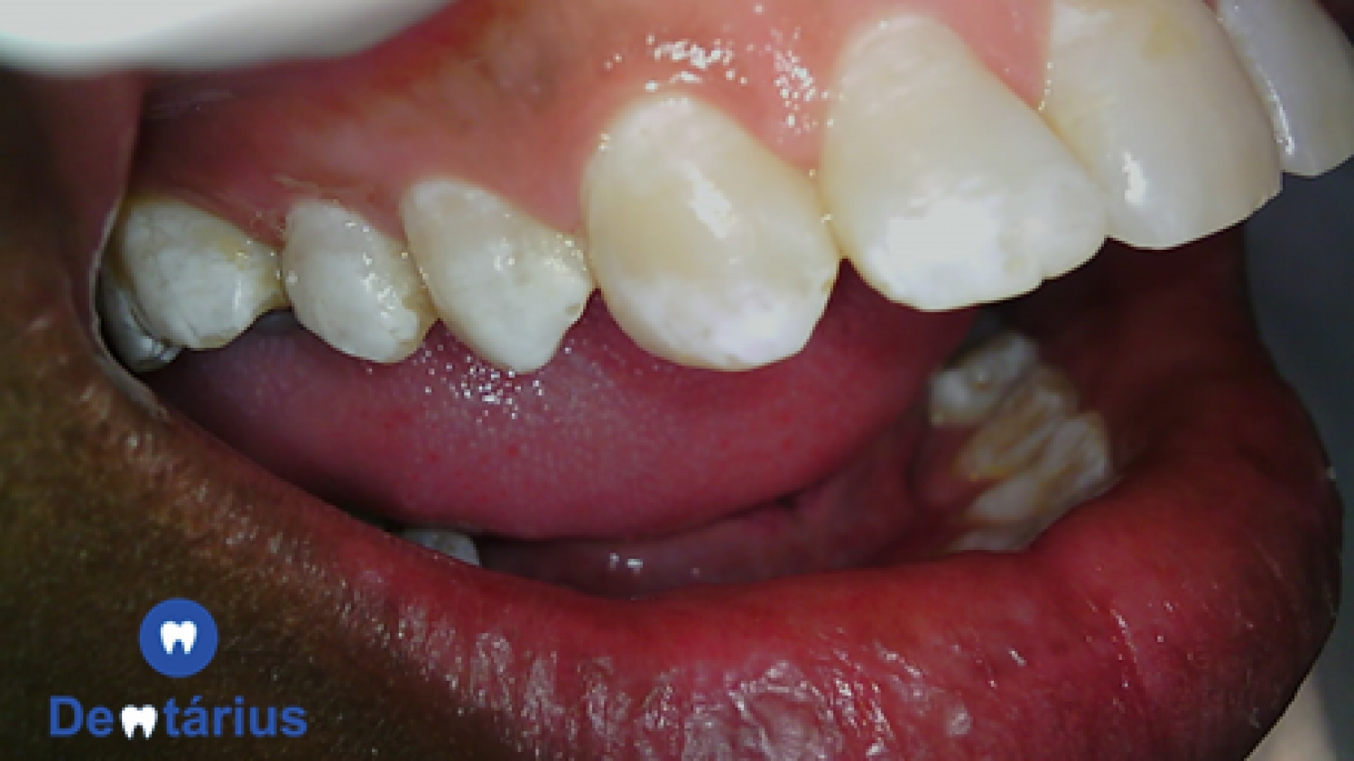 VOCÊ JÁ OUVIU FALAR EM FLUOROSE DENTAL?